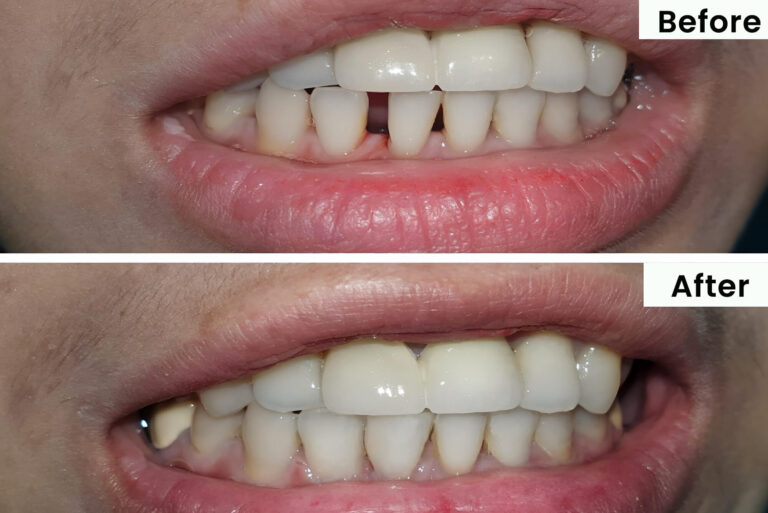 Invisalign in burnside