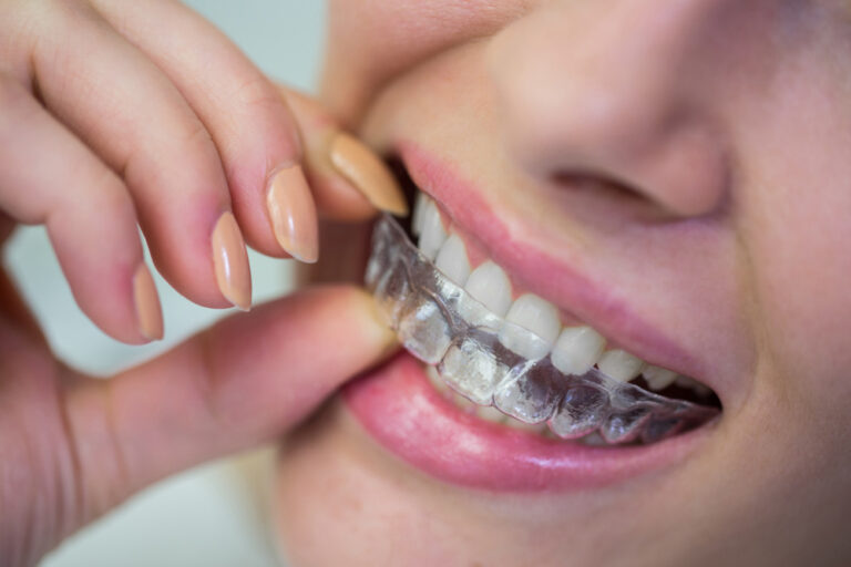 Invisalign in burnside adelaide