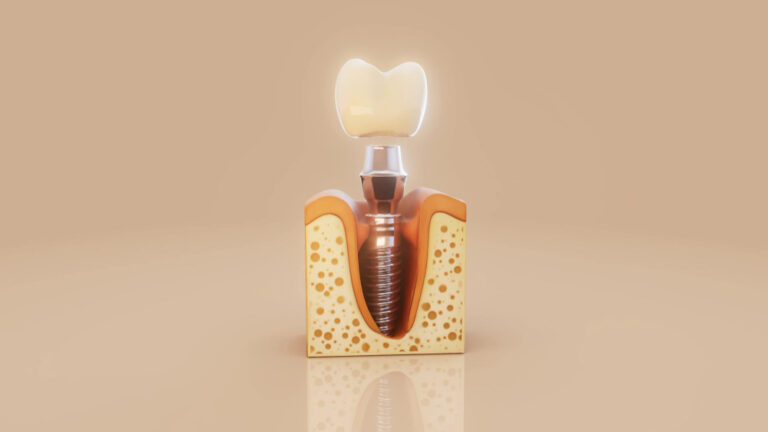 dental implants adelaide